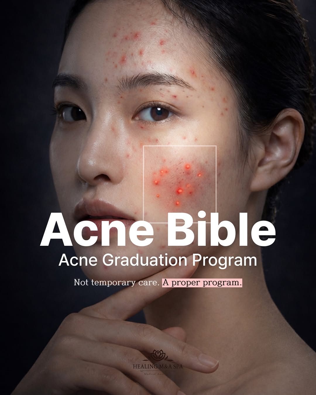 Acne Bible — Acne Graduation Program at Healing M&A Spa